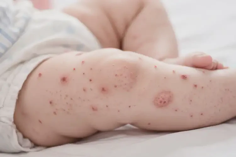 嬰兒大腿上經(jīng)常長濕疹可不可以徹底自愈(圖3)