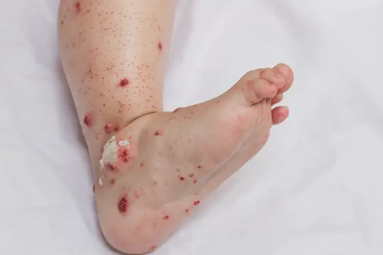 幼兒腳上偶爾長濕疹能靠自己自愈嗎(圖3)