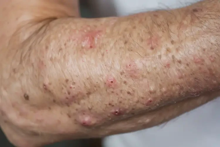 男性手臂偶爾長濕疹可不可以徹底自愈(圖4)