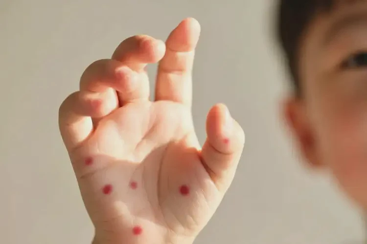 孩子四肢偶爾長濕疹不管它會自己痊愈嗎(圖4)