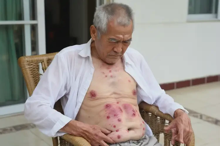 老人肚子上起濕疹不管它會自己自愈嗎(圖4)