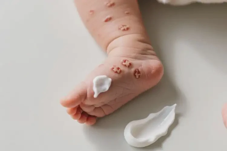 嬰幼兒腳上有濕疹不管它會(huì)自己痊愈嗎(圖2)