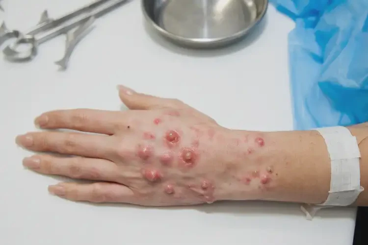 女生手上長濕疹能夠徹底治愈嗎(圖4)