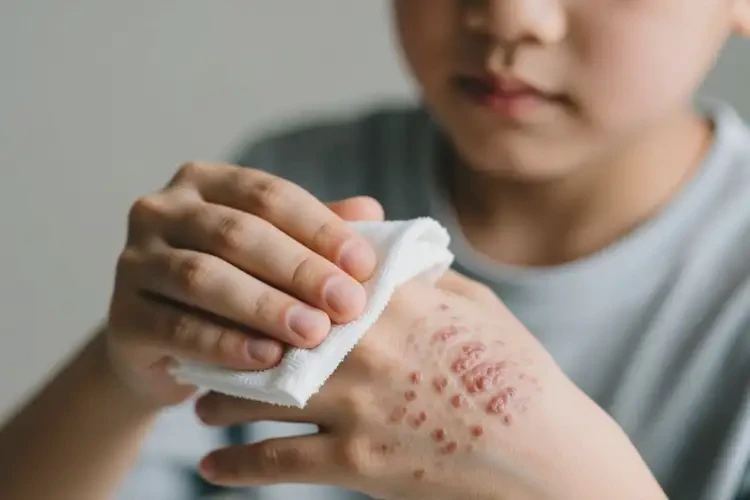 青年人手上起濕疹不管它會自己自愈嗎(圖1)