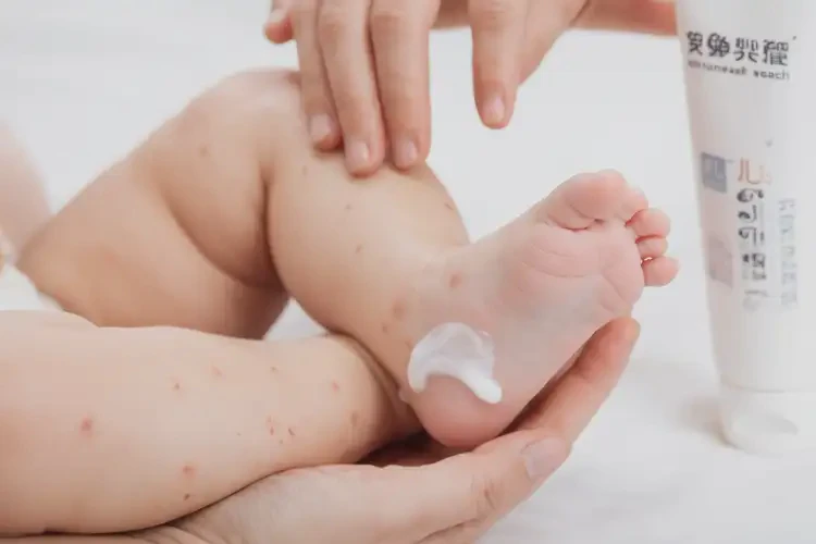 幼兒腳上偶爾長濕疹能靠自己自愈嗎(圖4)