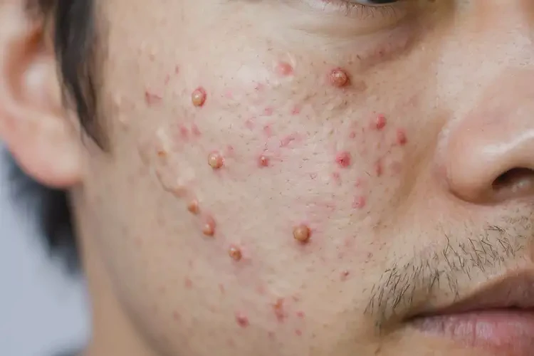 青年人面部起濕疹可不可以徹底自愈(圖4)