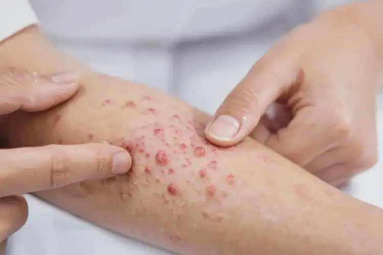 女生手臂出濕疹可不可以徹底自愈(圖4)