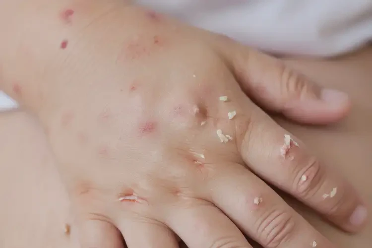 小孩手上有濕疹不管它會(huì)自己自愈嗎(圖4)