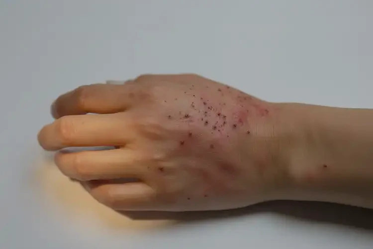 大學(xué)生手臂上出濕疹可以徹底自愈嗎(圖4)