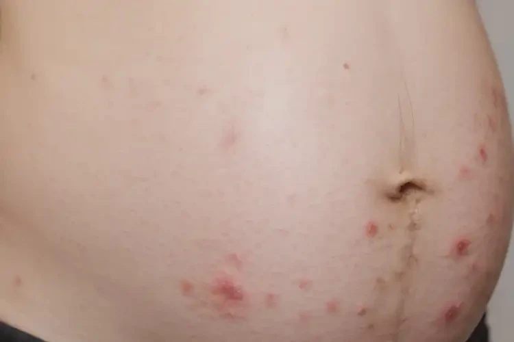 孕婦肚子上偶爾長濕疹能徹底自愈嗎(圖4)