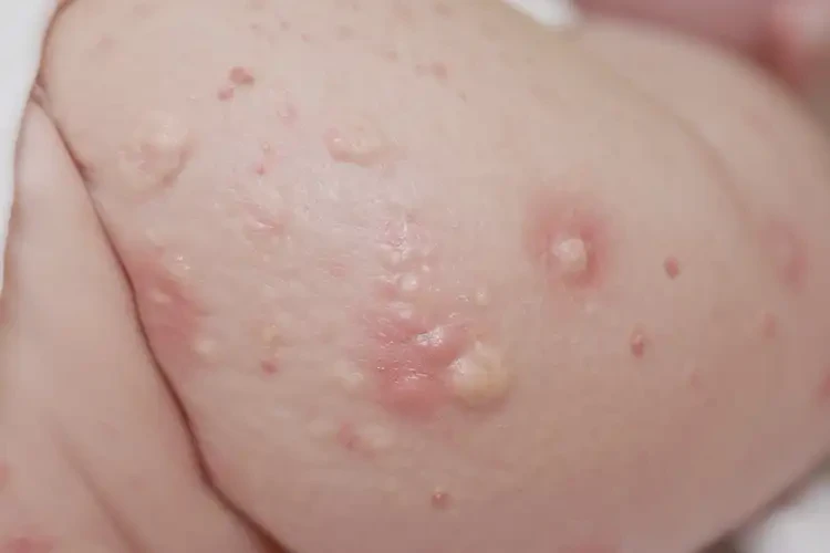 新生兒屁股上起濕疹能夠徹底治愈嗎(圖4)