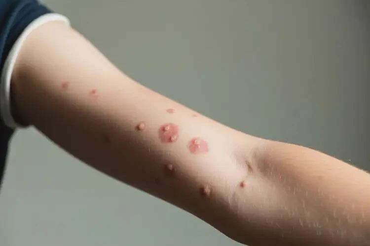 中學(xué)生手臂上偶爾起濕疹能徹底自愈嗎(圖2)