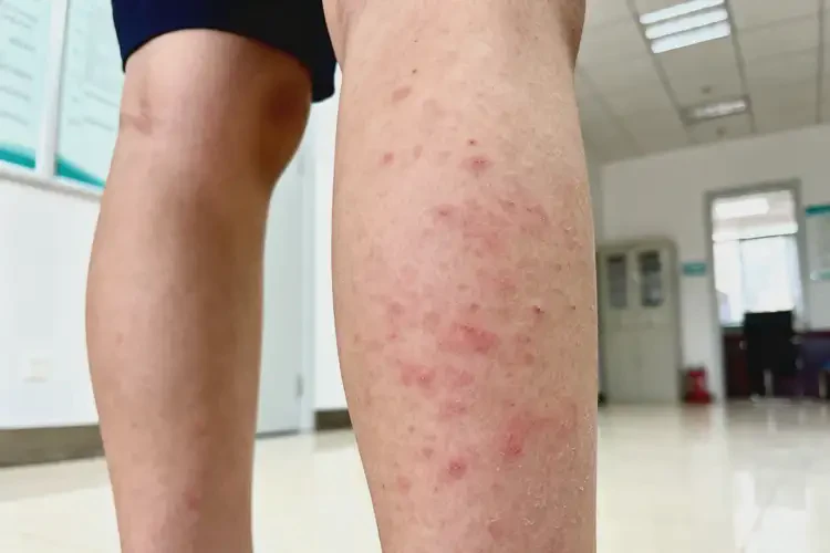 青少年小腿偶爾長濕疹可以徹底自愈嗎(圖1)