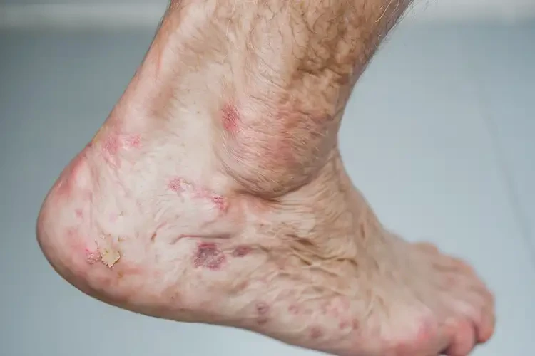 老人腳上容易長(zhǎng)濕疹能徹底自愈嗎(圖4)
