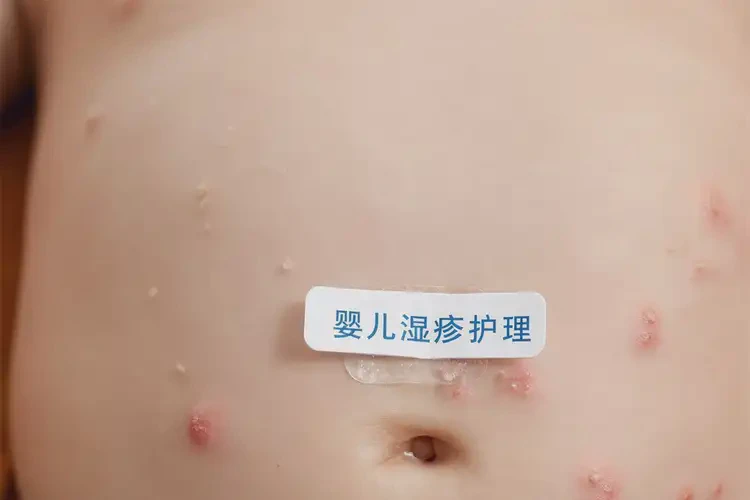 嬰兒肚子上容易起濕疹能靠自己自愈嗎(圖4)
