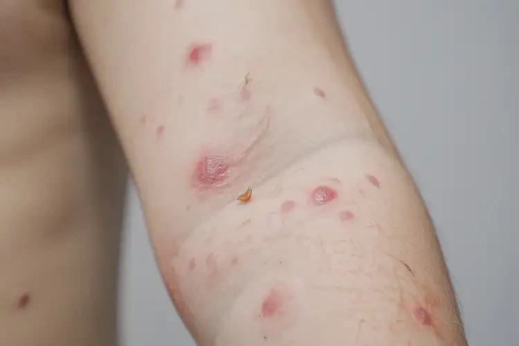 兒童全身容易起濕疹不管它會(huì)自己自愈嗎(圖4)