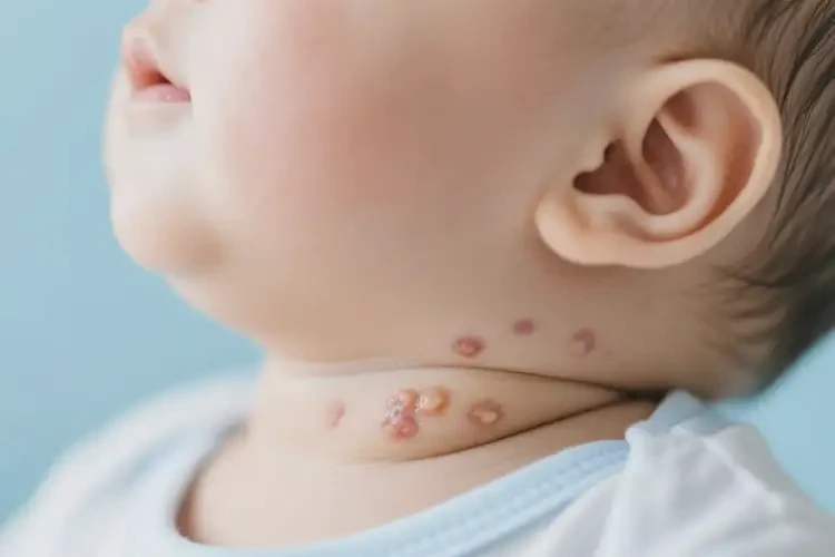 嬰兒脖子出現(xiàn)濕疹不管它會自己痊愈嗎(圖2)