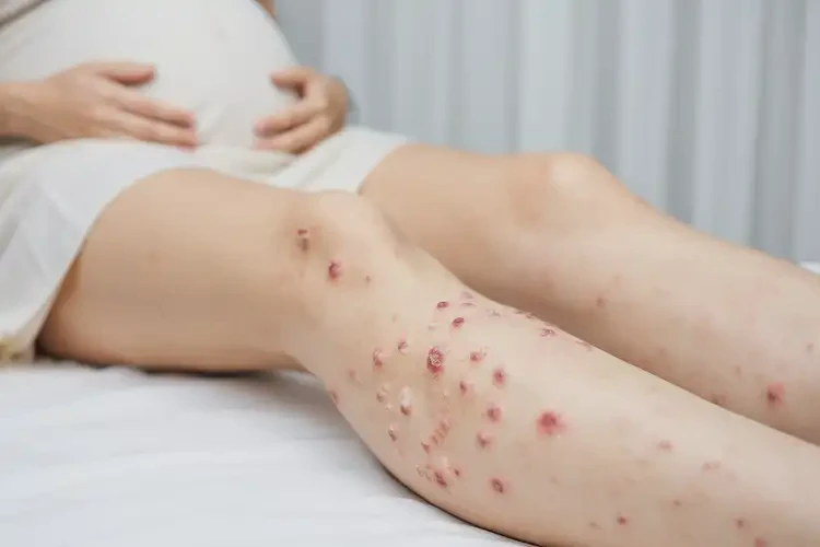 孕妇脚上容易长湿疹能靠自己自愈吗(图4)