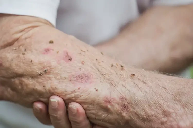 高齡老人手臂有濕疹能不能徹底自愈(圖4)