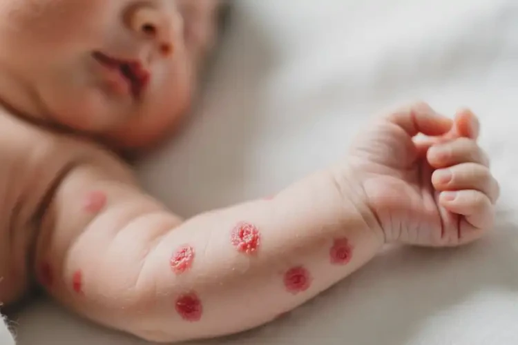 新生兒手臂上偶爾長(zhǎng)濕疹能靠自己自愈嗎(圖3)