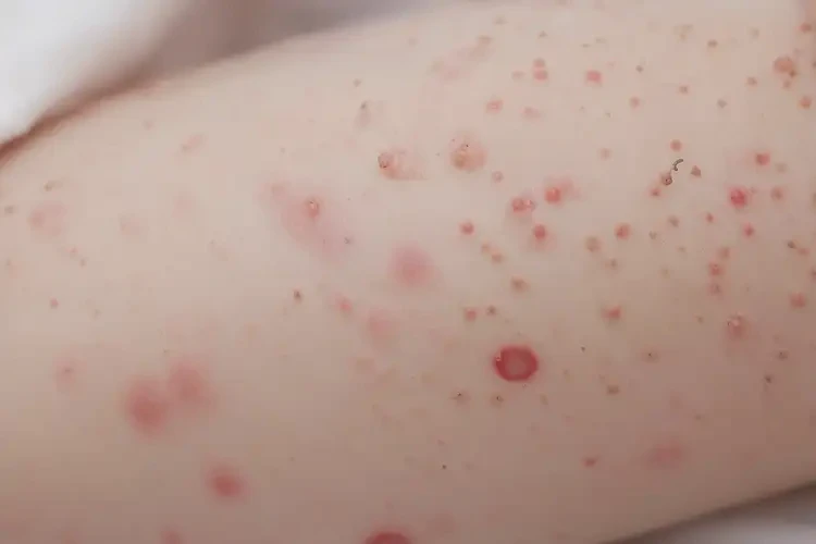 幼儿屁股上出湿疹不管它会自己痊愈吗(图4)