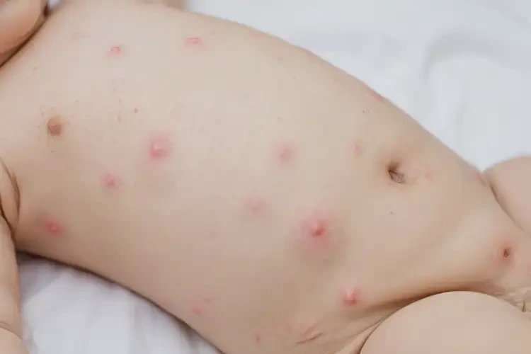 幼兒肚子偶爾長濕疹能徹底自愈嗎(圖4)