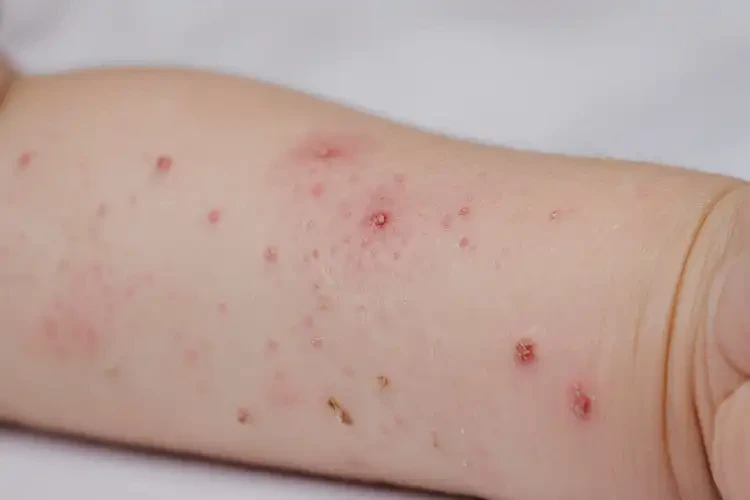 幼兒手臂有濕疹可以徹底自愈嗎(圖4)