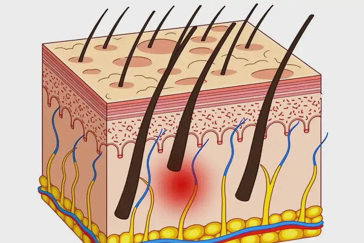 中學(xué)生肚子上經(jīng)常起濕疹不管它會(huì)自己自愈嗎(圖1)