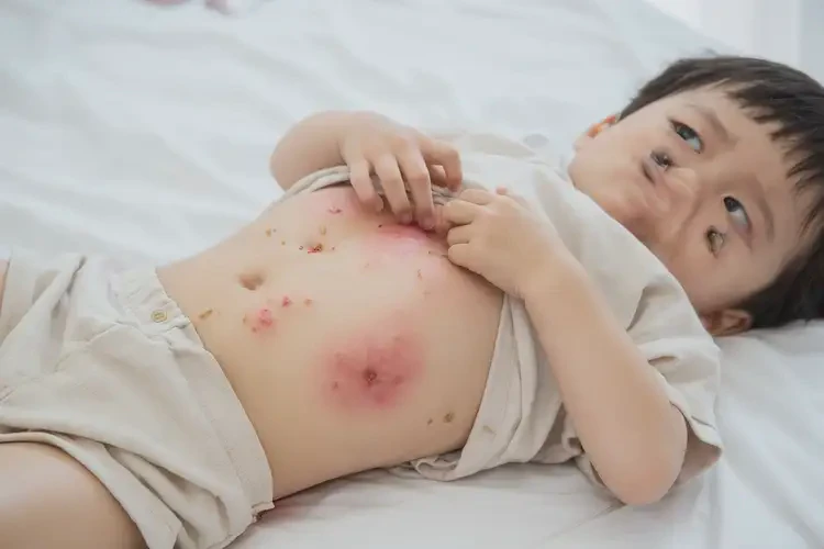 幼儿肚子上经常起湿疹不管它会自己好吗(图4)