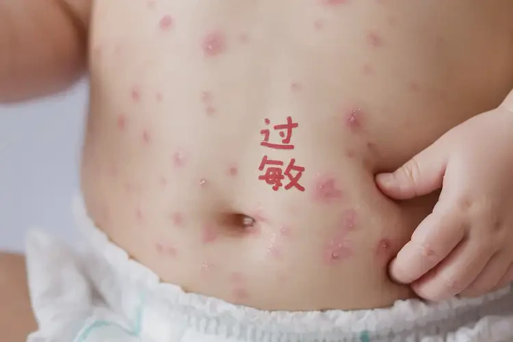 幼兒肚子上有濕疹可不可以徹底自愈(圖4)