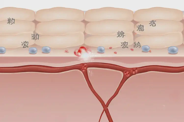 中學(xué)生屁股上偶爾起濕疹不管它會自己痊愈嗎(圖3)