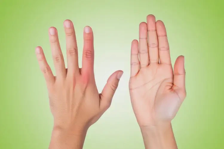 大學(xué)生手上容易起濕疹不管它會自己好嗎(圖3)