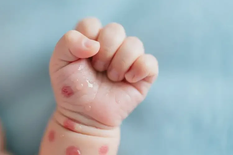 新生兒手上容易起濕疹不管它會自己痊愈嗎(圖1)