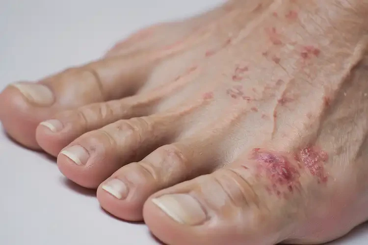 老年人腳上經(jīng)常長(zhǎng)濕疹能不能徹底自愈(圖4)