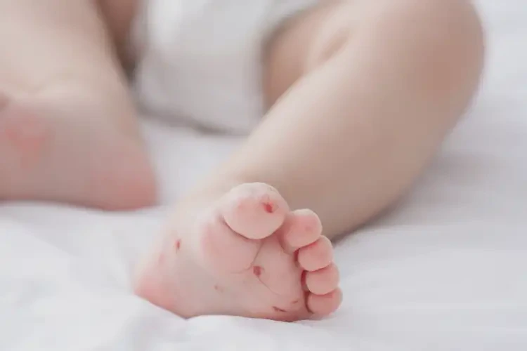 婴儿脚上偶尔起湿疹不管它会自己好吗(图1)