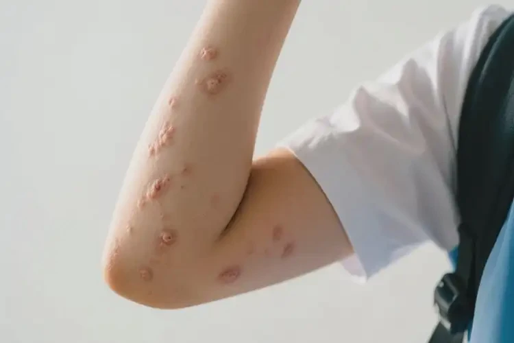 中學(xué)生手臂上偶爾起濕疹能徹底自愈嗎(圖4)