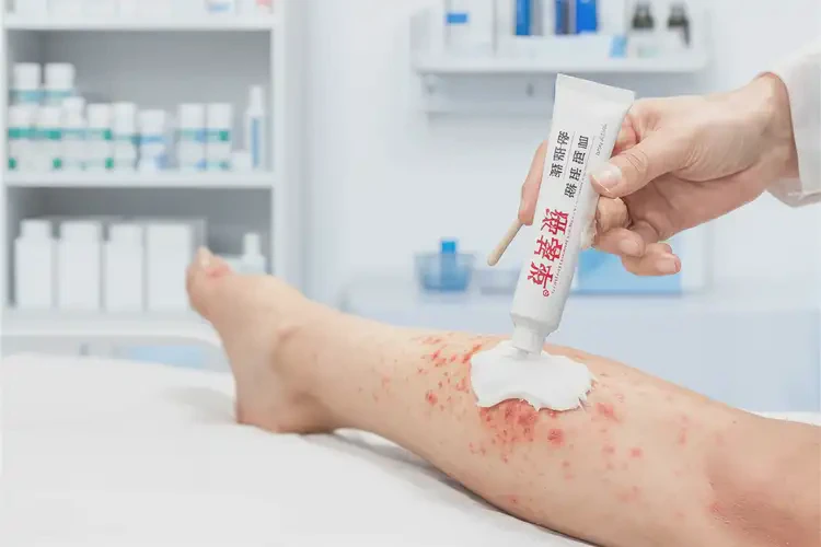 青少年小腿經(jīng)常長濕疹不管它會自己自愈嗎(圖3)