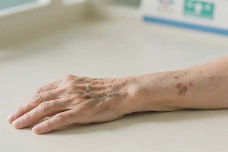 老年人手臂上長濕疹可不可以徹底自愈(圖4)