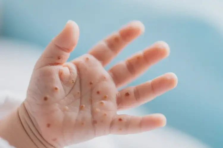 新生兒手上偶爾起濕疹能靠自己自愈嗎(圖1)