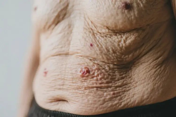 高齡老人肚子上起濕疹不管它會自己痊愈嗎(圖2)