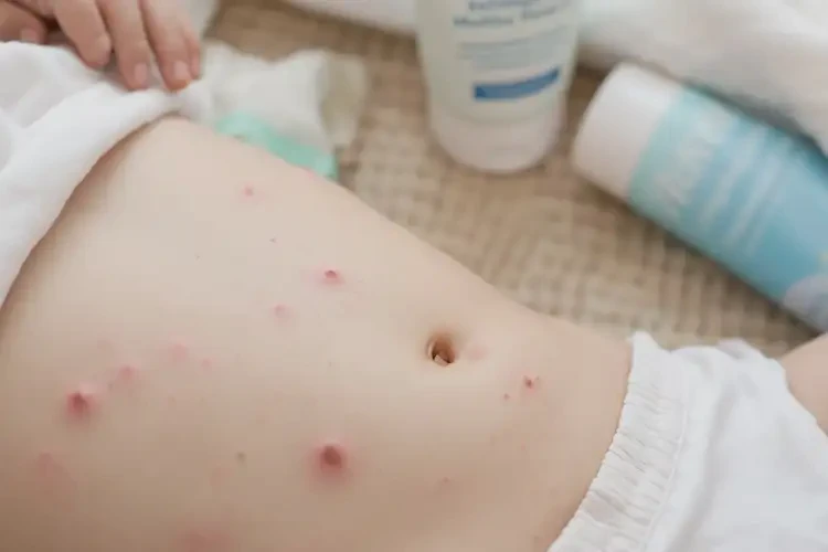 幼兒肚子偶爾長濕疹能徹底自愈嗎(圖3)