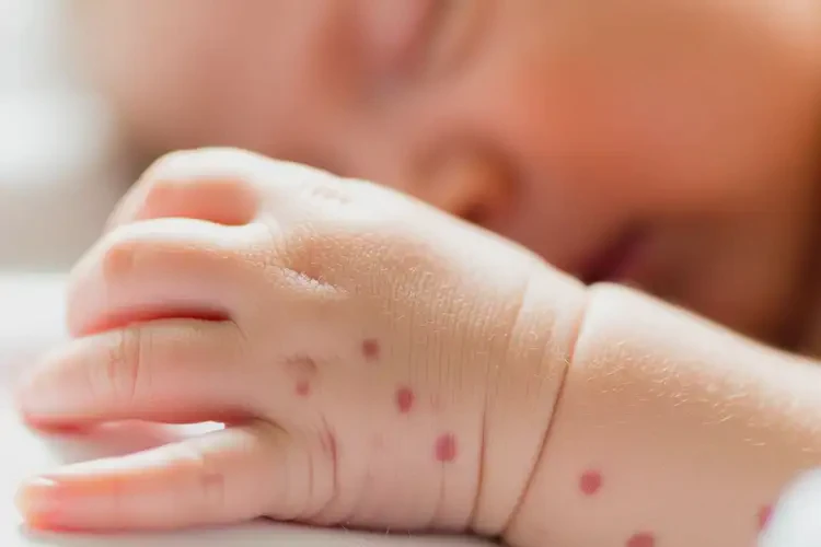新生兒手上容易起濕疹能靠自己自愈嗎(圖4)