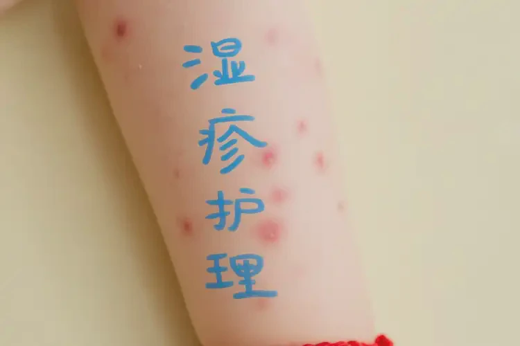 少兒屁股偶爾起濕疹可以徹底自愈嗎(圖4)