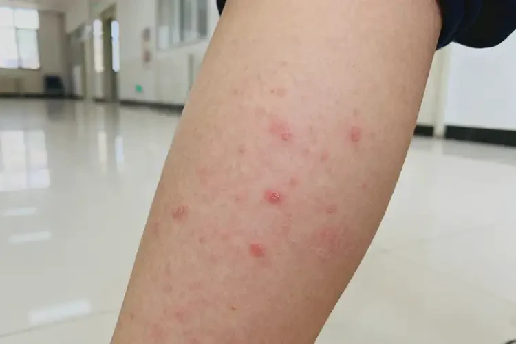 青少年小腿偶爾長濕疹可以徹底自愈嗎(圖3)