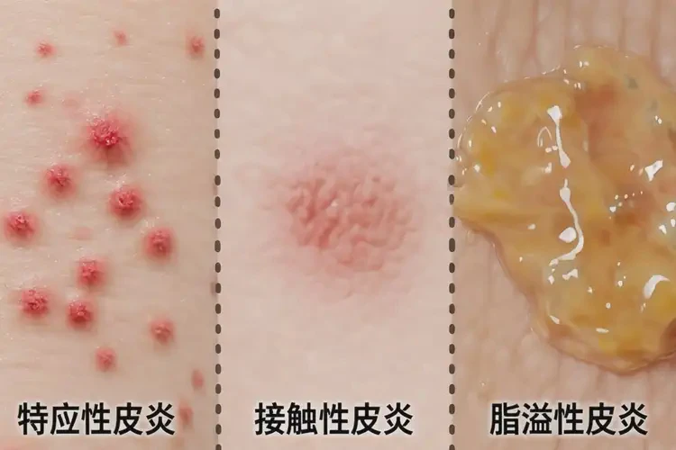 男性大腿上出濕疹能靠自己自愈嗎(圖3)