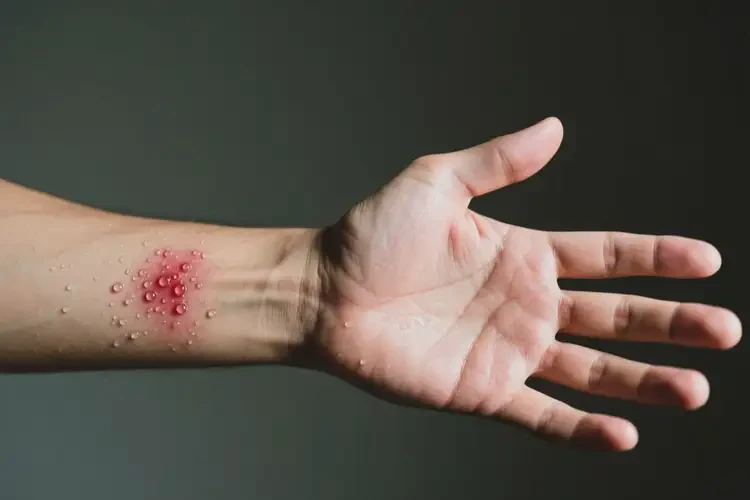 男性手臂長濕疹能靠自己自愈嗎(圖2)