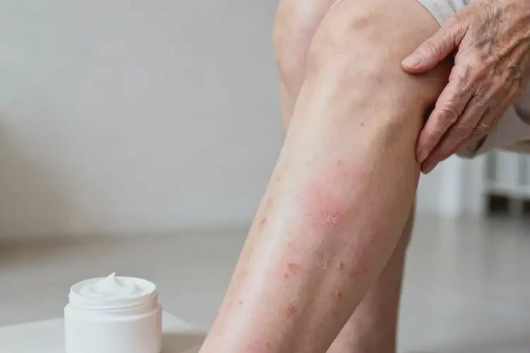 老年人小腿出濕疹不管它會(huì)自己痊愈嗎(圖3)