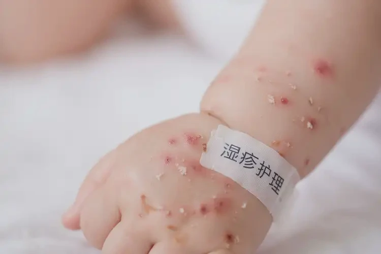 寶寶手臂上容易起濕疹不管它會自己自愈嗎(圖4)