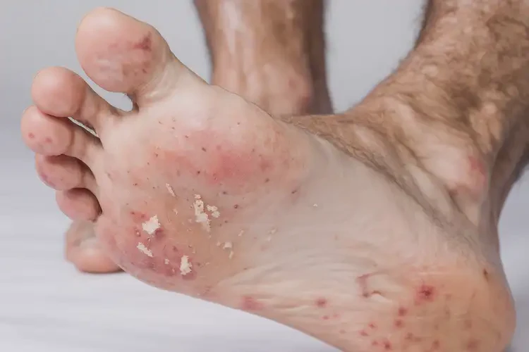 男生脚上经常长湿疹能彻底自愈吗(图4)