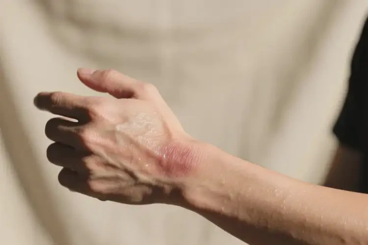 男人手臂上出湿疹可不可以彻底自愈(图3)